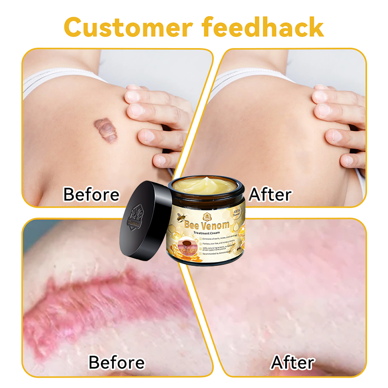 Turonuβ’ Bee Venom Skin Treatment Creamπ©πΌββοΈοΌπ΄π΄π· π
πππππππππποΌ (π₯π³πππ π
ππ πππππππππ 80% πππ)