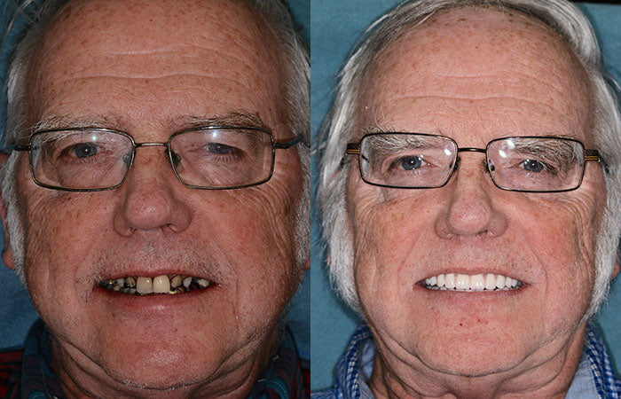 𝐁𝐢𝐤𝐞𝐧𝐝𝐚® --🦷Advanced Customized Full Denture Set 🗽🇺🇸 (⏰Limited time discount last 30 minutes⏰)