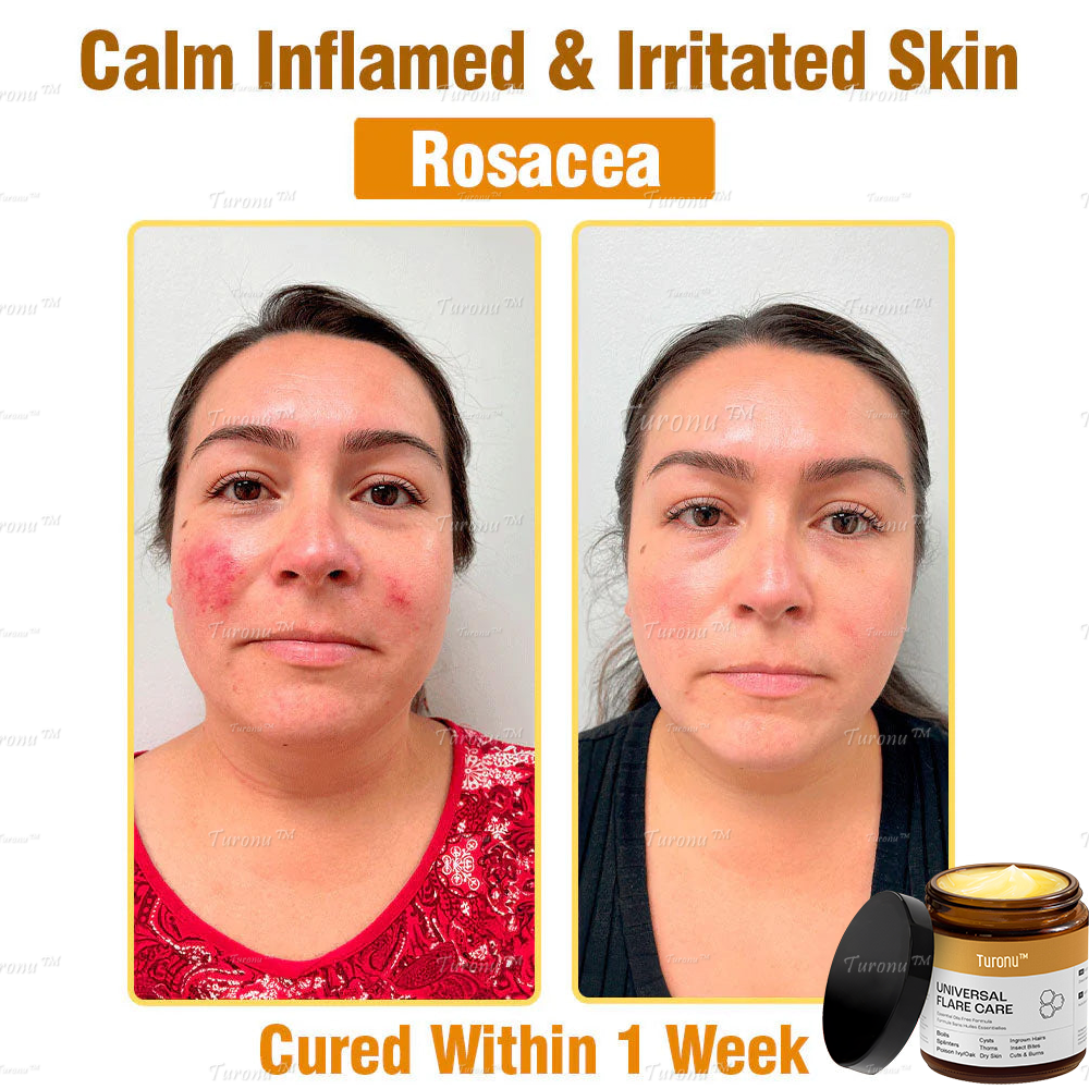 Official Store:𝐏𝐫𝐨𝐩𝐨𝐥𝐢𝐬 𝐓𝐫𝐞𝐚𝐭𝐦𝐞𝐧𝐭 𝐎𝐢𝐧𝐭𝐦𝐞𝐧𝐭👩🏼‍⚕️𝐀𝐀𝐃 𝐑𝐄𝐂𝐎𝐌𝐌𝐄𝐍𝐃𝐒(🔥55% Off for a Limited Time!)