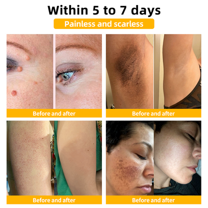 Turonu™ Bee Venom Skin Treatment Cream👩🏼‍⚕️（𝐴𝐴𝐷 𝑅𝑒𝑐𝑜𝑚𝑚𝑒𝑛𝑑𝑒𝑑） (🔥𝑳𝒂𝒔𝒕 𝒅𝒂𝒚 𝒑𝒓𝒐𝒎𝒐𝒕𝒊𝒐𝒏 80% 𝒐𝒇𝒇)