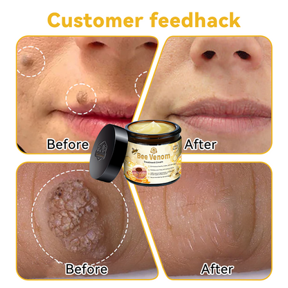 Turonu™ Bee Venom Skin Treatment Cream👩🏼‍⚕️（𝐴𝐴𝐷 𝑅𝑒𝑐𝑜𝑚𝑚𝑒𝑛𝑑𝑒𝑑） (🔥𝑳𝒂𝒔𝒕 𝒅𝒂𝒚 𝒑𝒓𝒐𝒎𝒐𝒕𝒊𝒐𝒏 80% 𝒐𝒇𝒇)