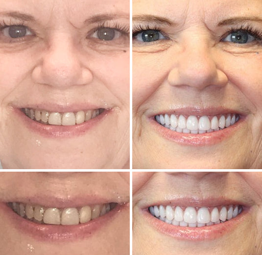 𝐁𝐢𝐤𝐞𝐧𝐝𝐚® --🦷Advanced Customized Full Denture Set 🗽🇺🇸 (⏰Limited time discount last 30 minutes⏰)