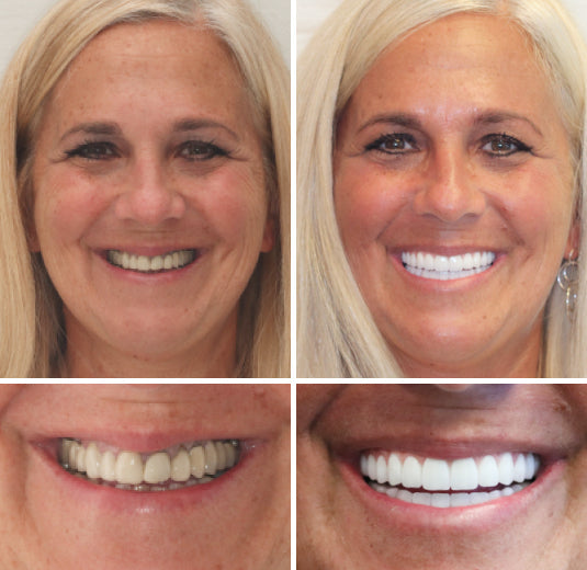 𝐁𝐢𝐤𝐞𝐧𝐝𝐚® --🦷Advanced Customized Full Denture Set 🗽🇺🇸 (⏰Limited time discount last 30 minutes⏰)