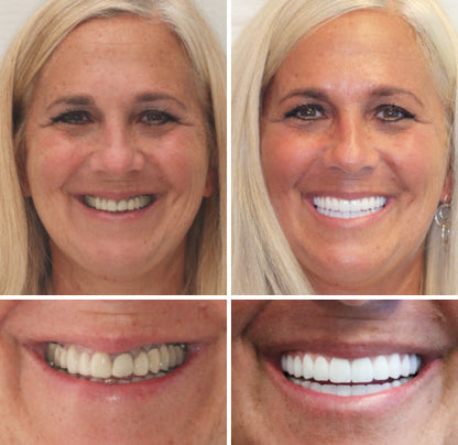 𝐁𝐢𝐤𝐞𝐧𝐝𝐚® --🦷Advanced Customized Full Denture Set 🗽🇺🇸 (⏰Limited time discount last 30 minutes⏰)